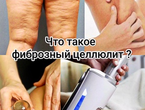 Что такое фиброзный целлюлит?